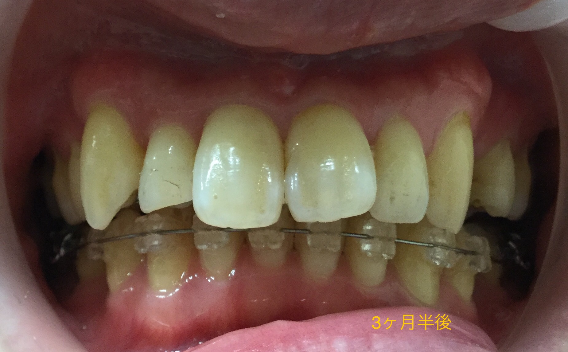３０代　出っ歯＋八重歯の改善（３ヶ月半後）