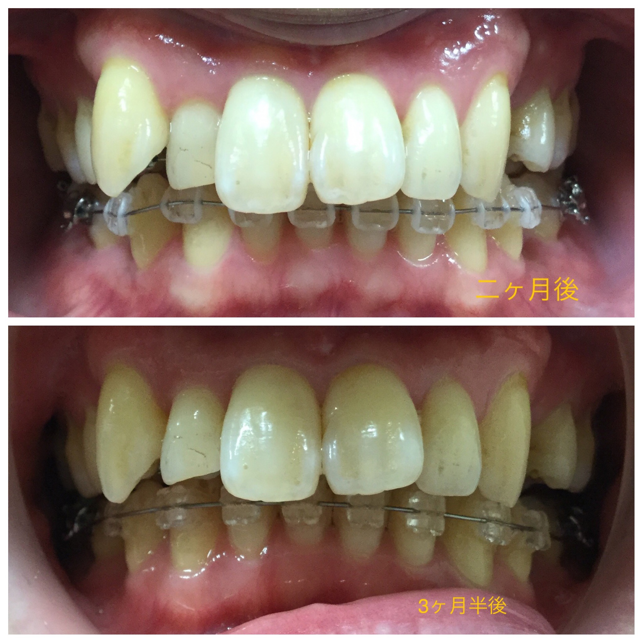 ３０代　出っ歯＋八重歯の改善（３ヶ月半後）