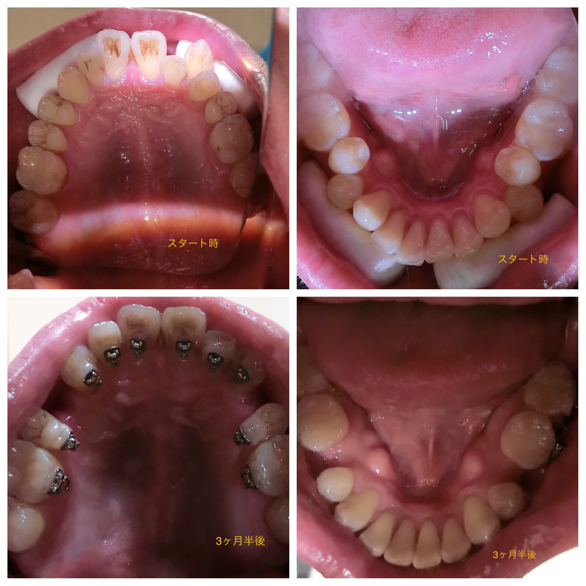 ３０代　出っ歯＋八重歯の改善（３ヶ月半後）