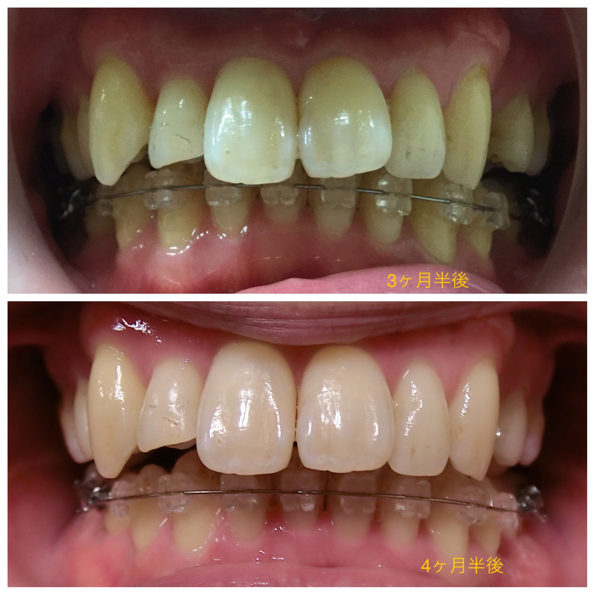 ３０代　出っ歯＋八重歯の改善（４ヶ月半後）