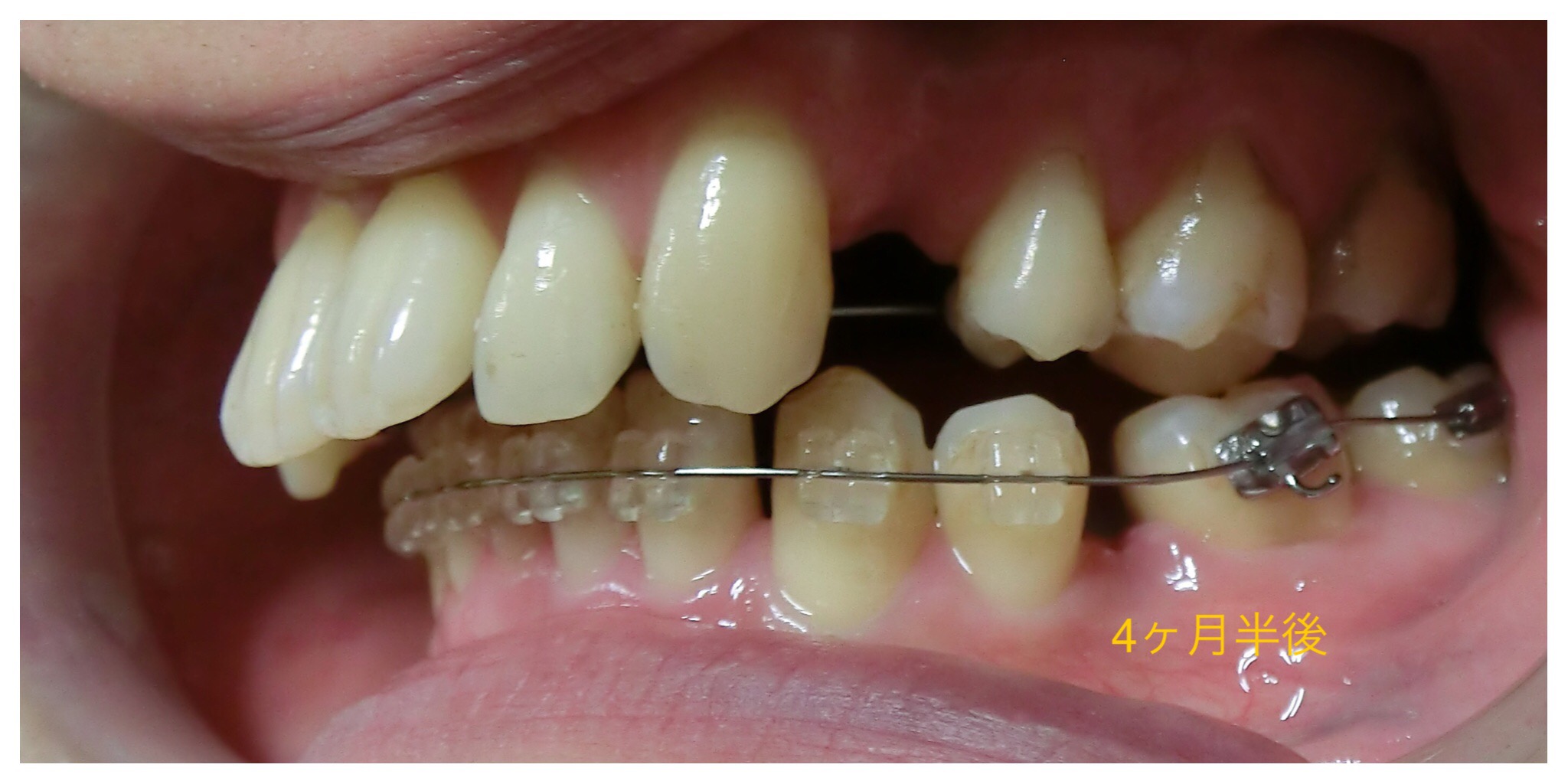 ３０代　出っ歯＋八重歯の改善（４ヶ月半後）