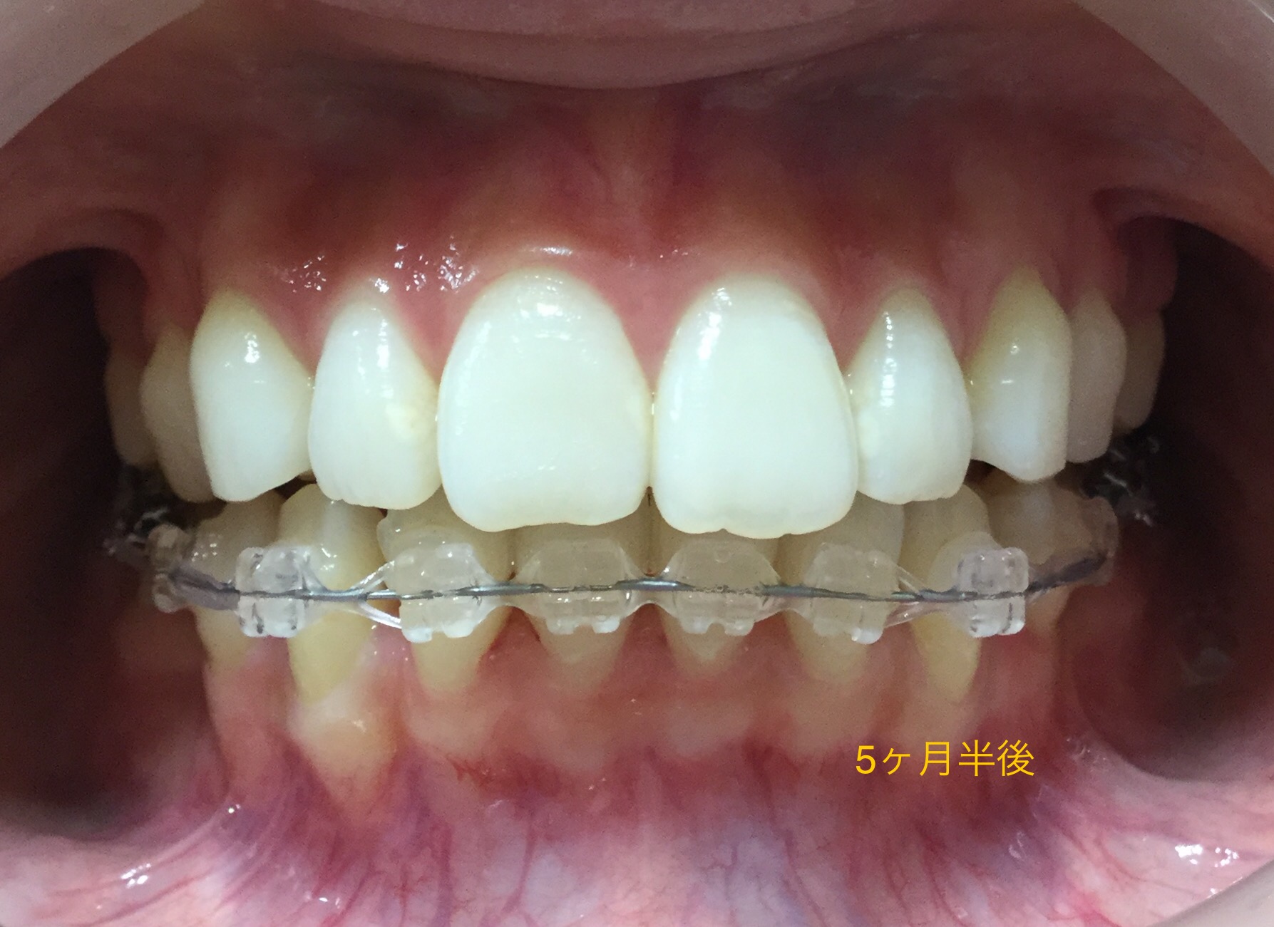 前歯２本が出ている症例（５ヶ月半後）