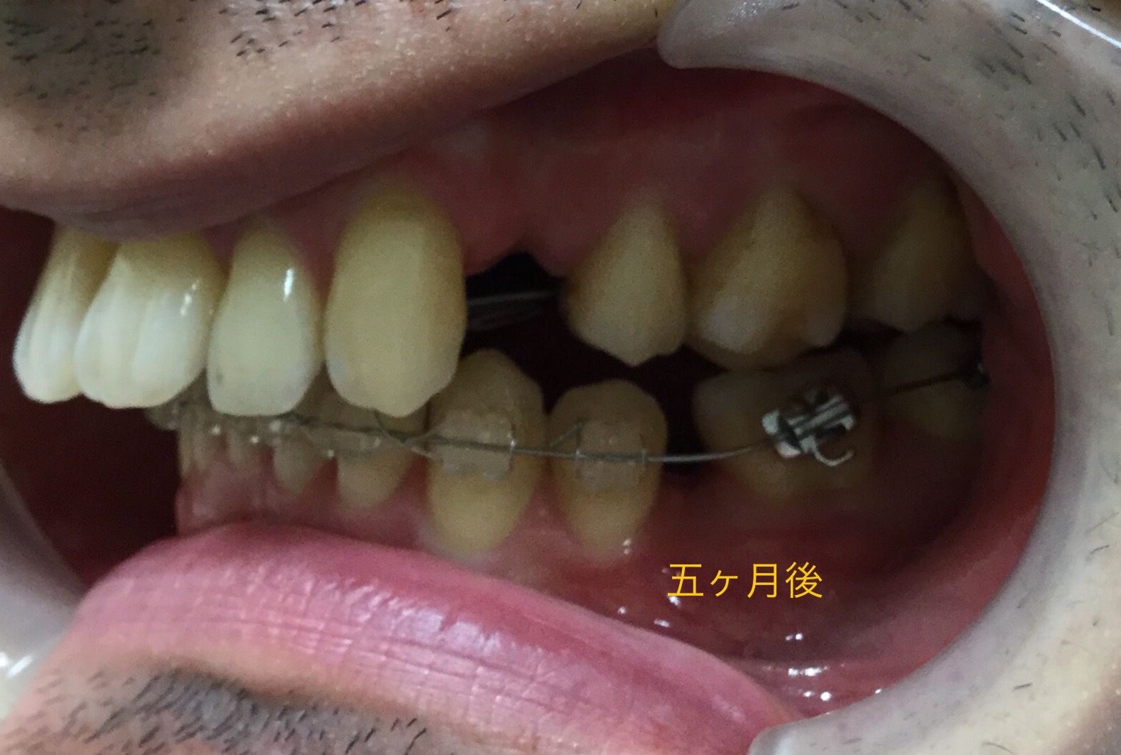 ３０代　出っ歯＋八重歯の改善（5ヶ月半後）