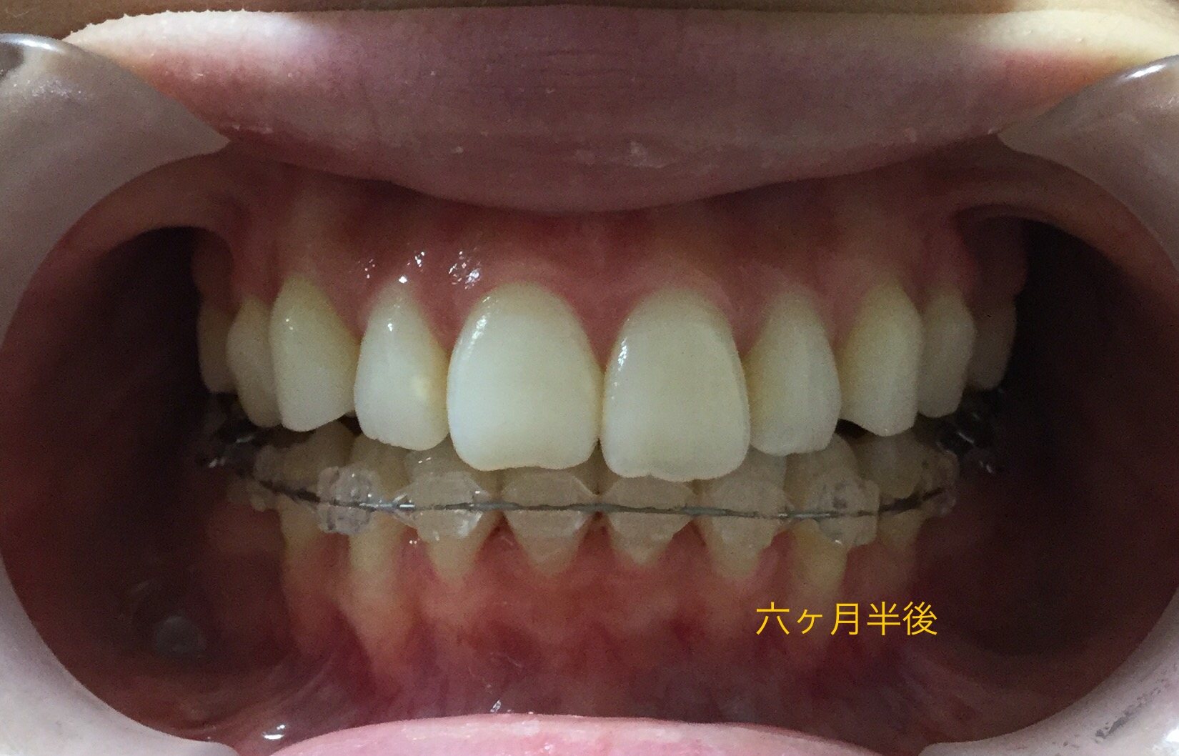 前歯２本が出ている症例（６ヶ月半後）