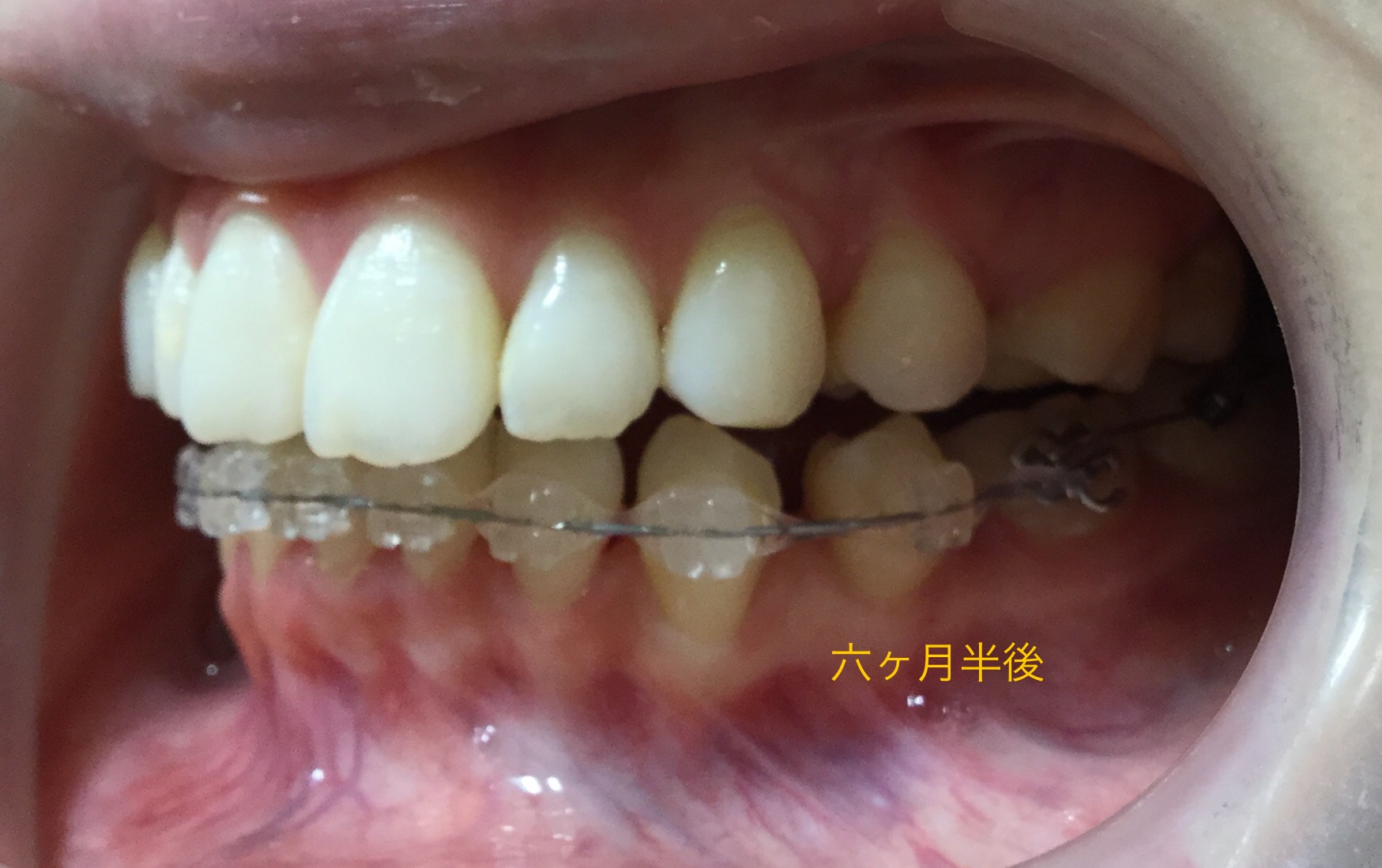 前歯２本が出ている症例（６ヶ月半後）