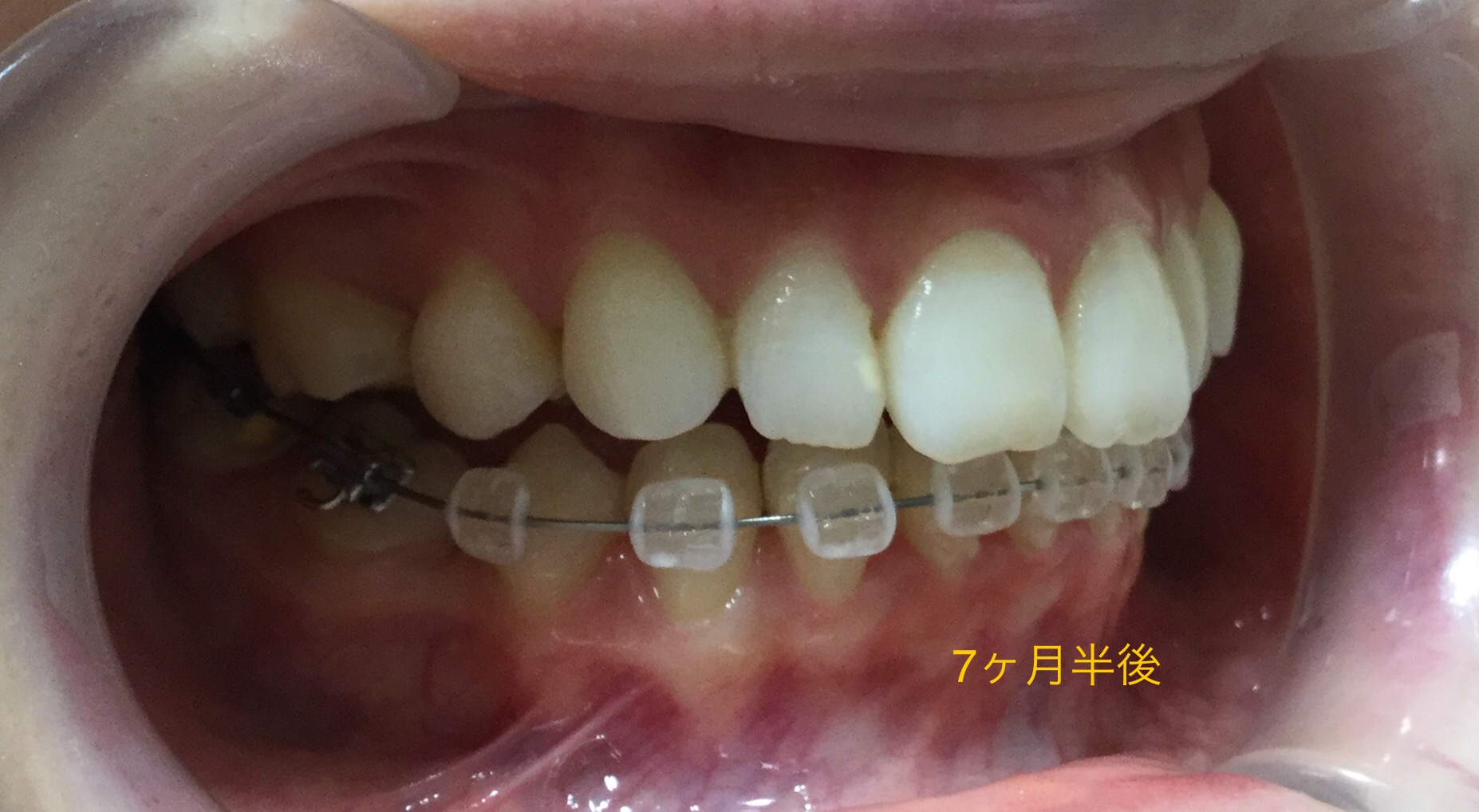前歯２本が出ている症例（７ヶ月半後）