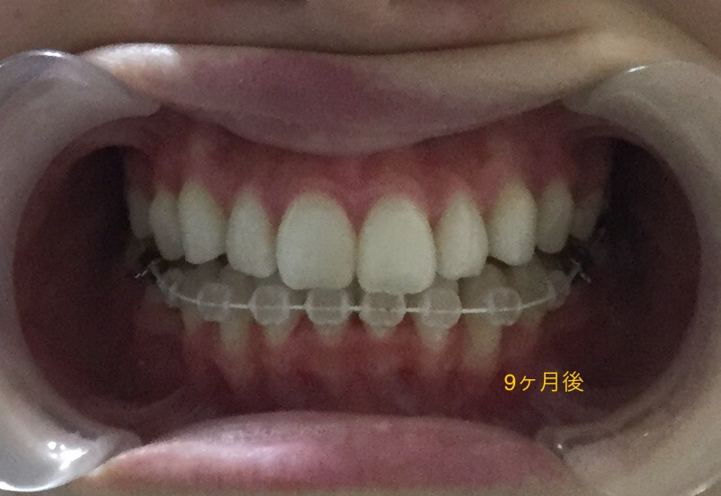 前歯２本が出ている症例（９ヶ月後）