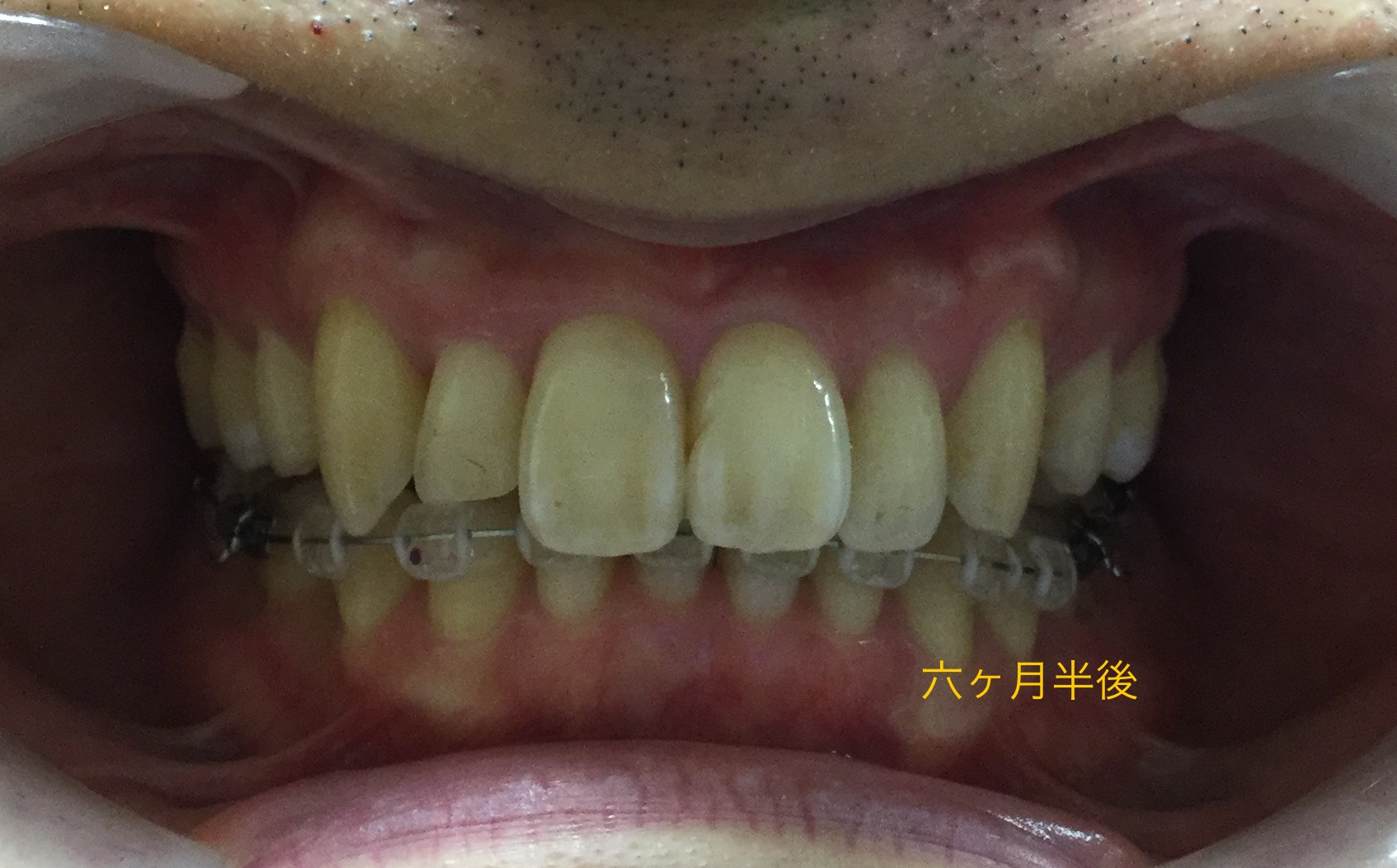 ３０代　出っ歯＋八重歯の改善（６ヶ月半後）