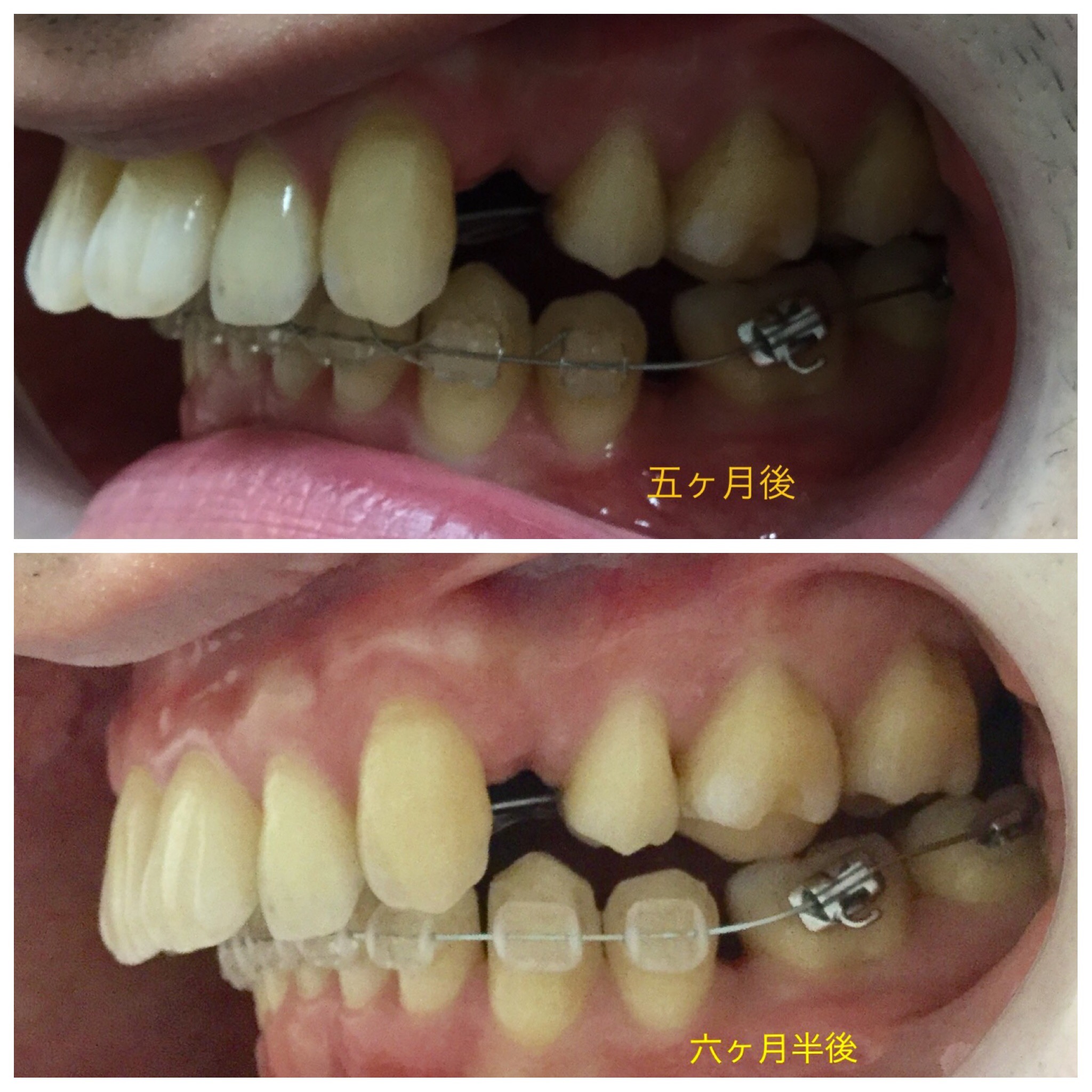 ３０代　出っ歯＋八重歯の改善（６ヶ月半後）