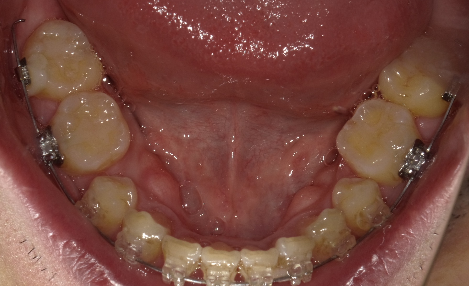 ３０代　出っ歯＋八重歯の改善（８ヶ月後）
