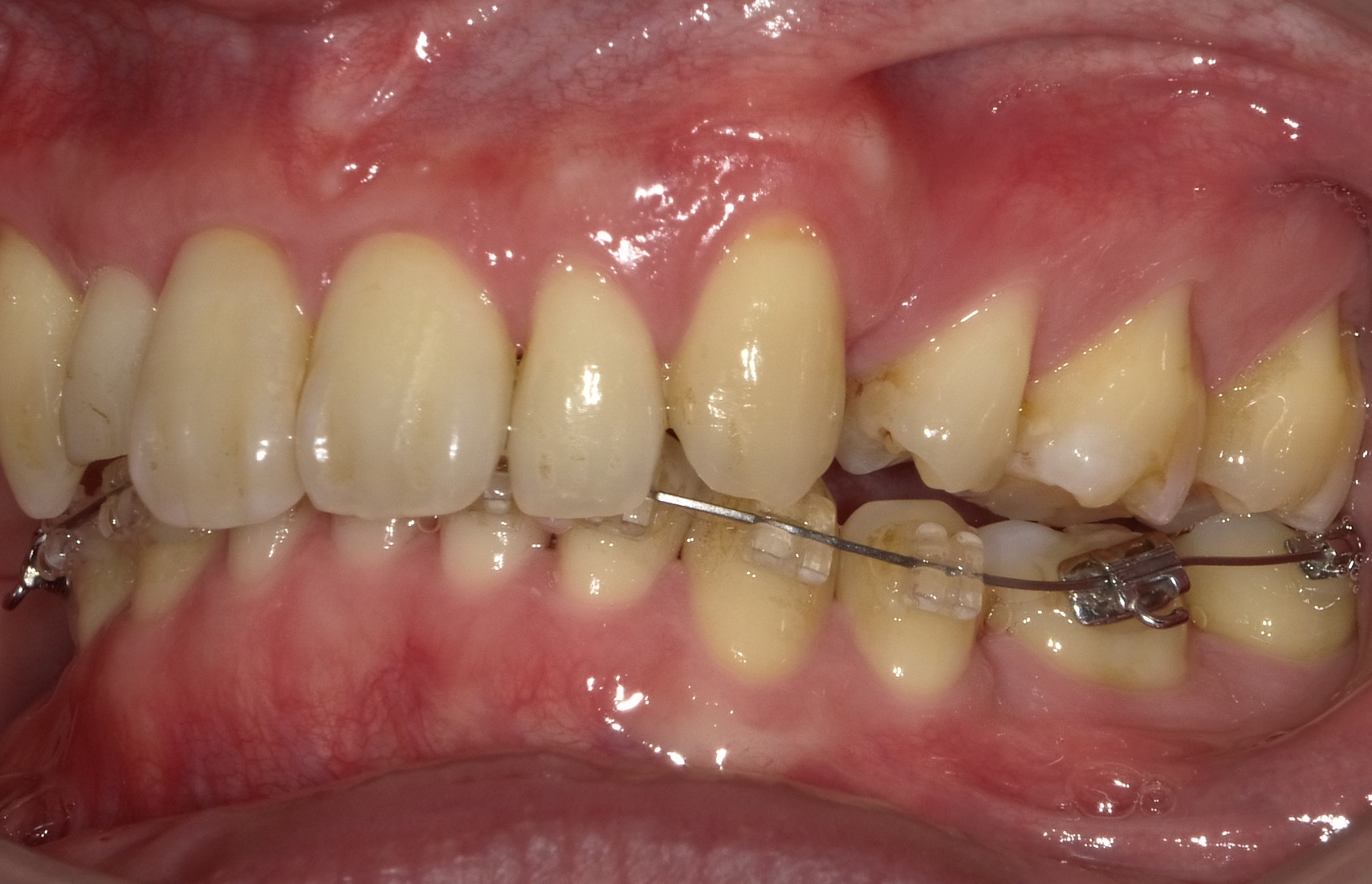 ３０代　出っ歯＋八重歯の改善（８ヶ月後）