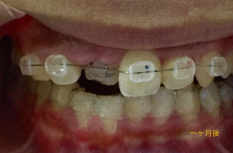 前歯が一本だけ入り込んだ症例（一ヶ月後）