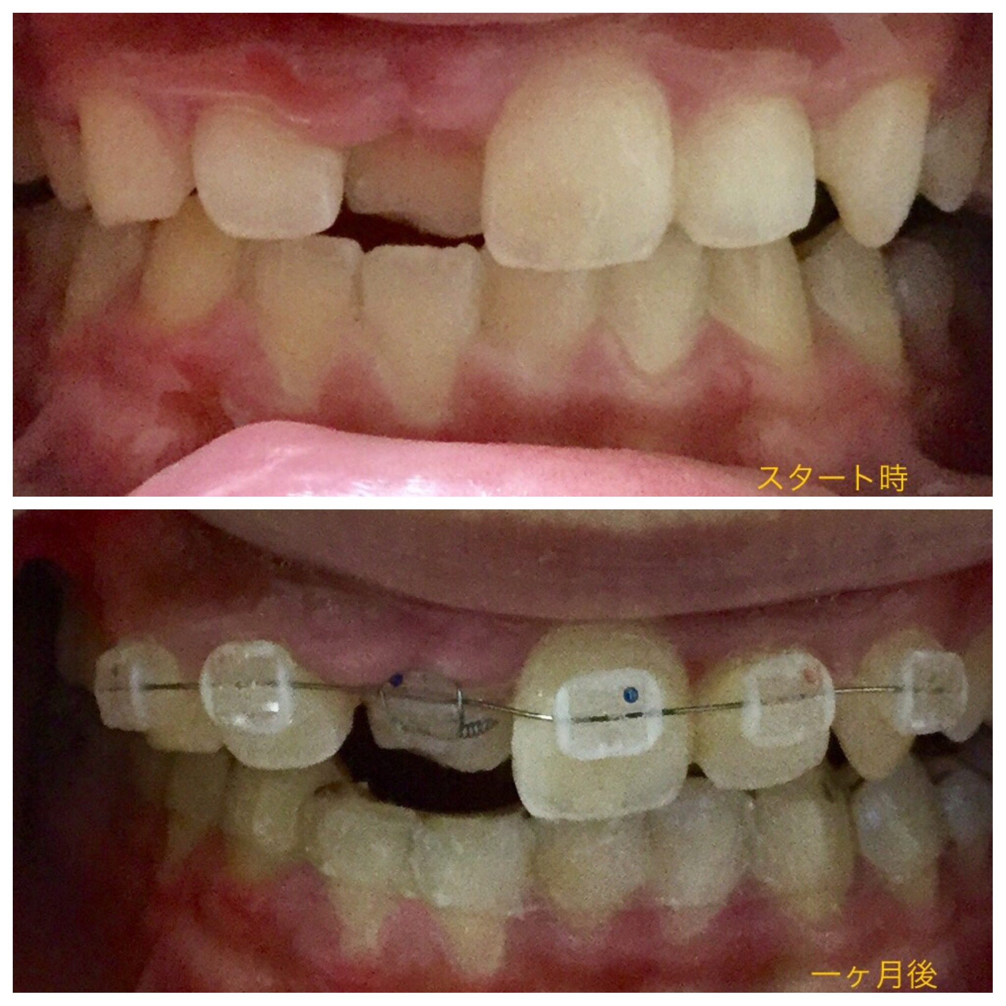 前歯が一本だけ入り込んだ症例（一ヶ月後）