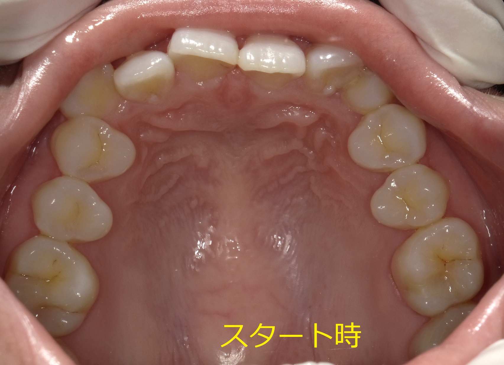 結婚式に向けた矯正治療。　②