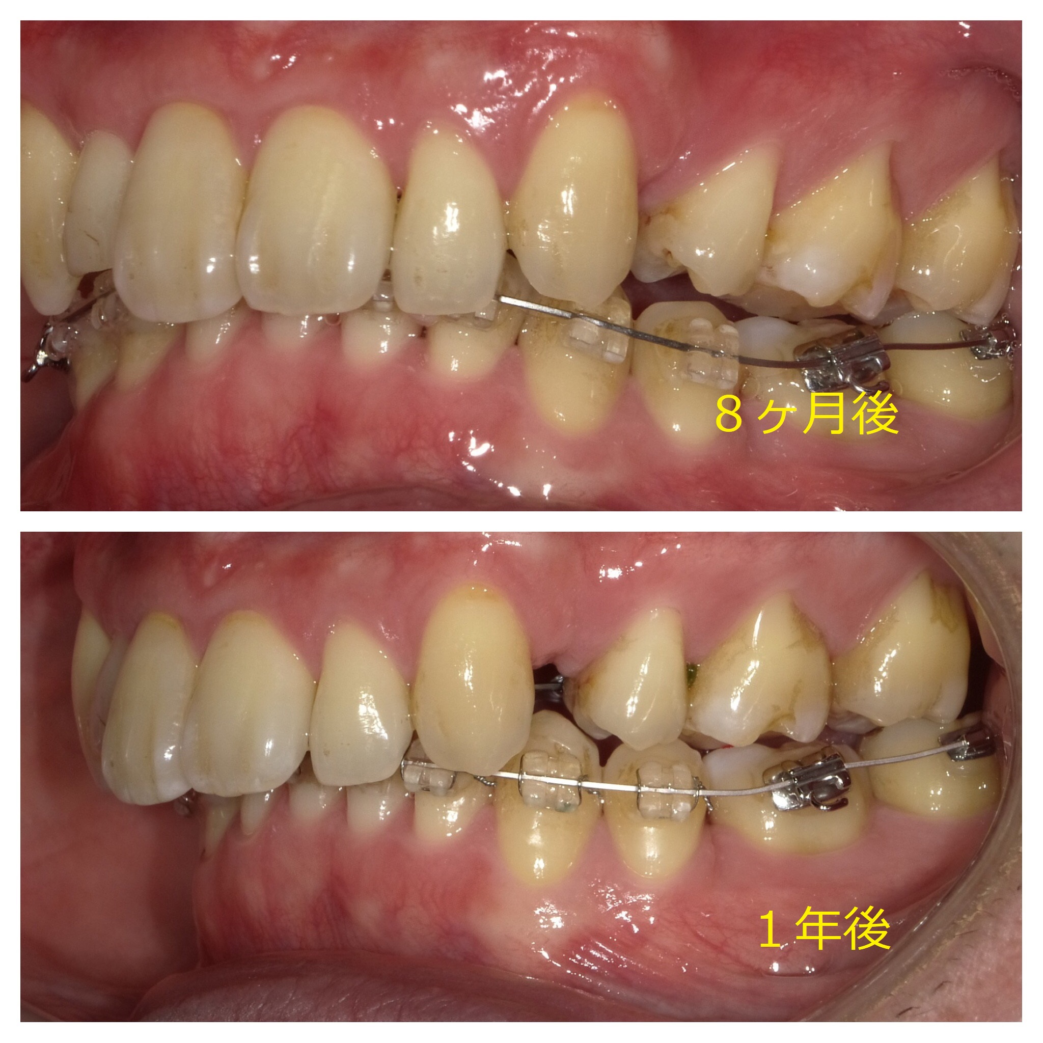 ３０代　出っ歯＋八重歯の改善（１年後）