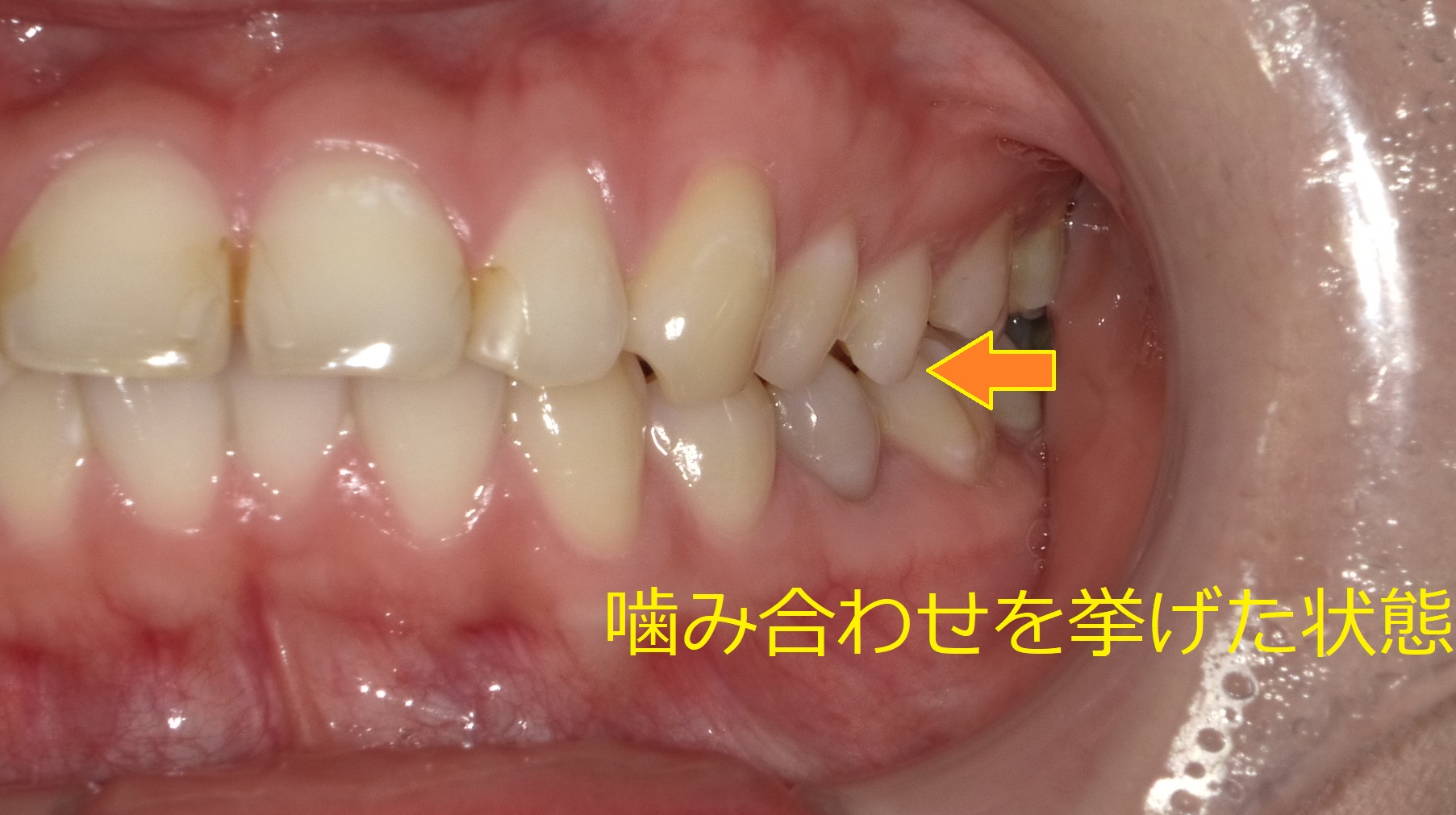 上顎のみの全体矯正。～出っ歯の改善～　②