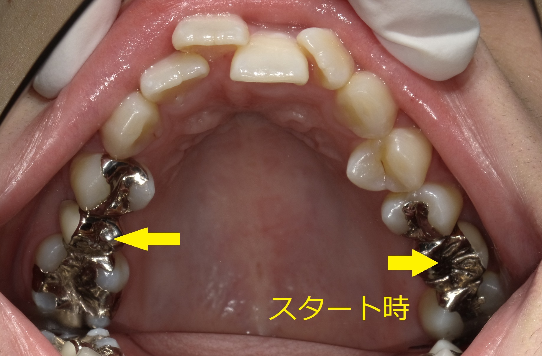 上顎のみ＋欠損スペースを利用しての矯正　①