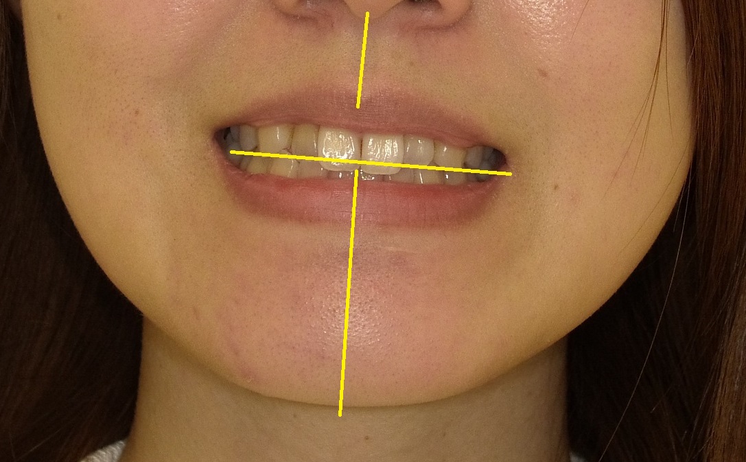 上顎が小さく、前歯が一本交差している症例　①