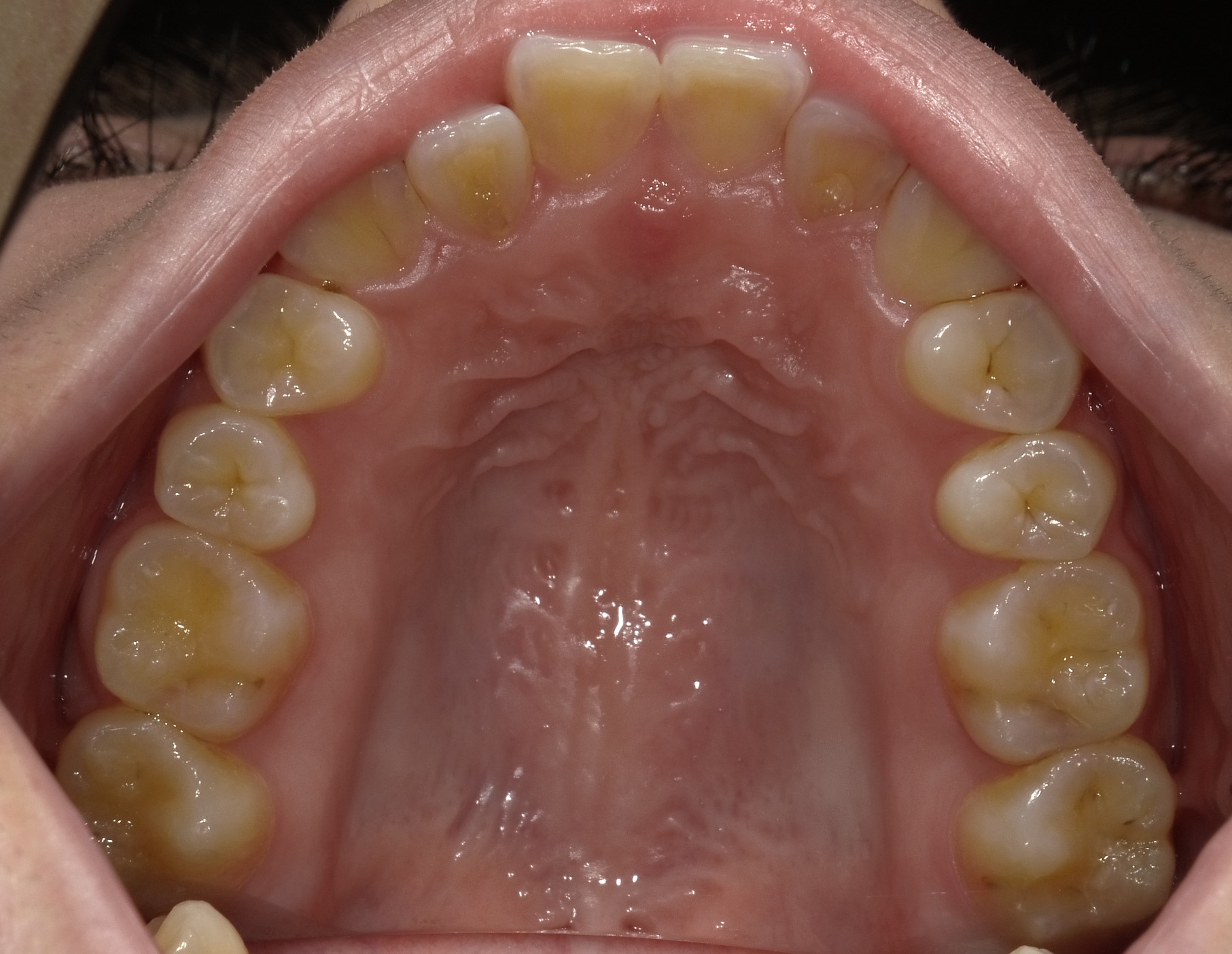上顎が小さく、前歯が一本交差している症例　①