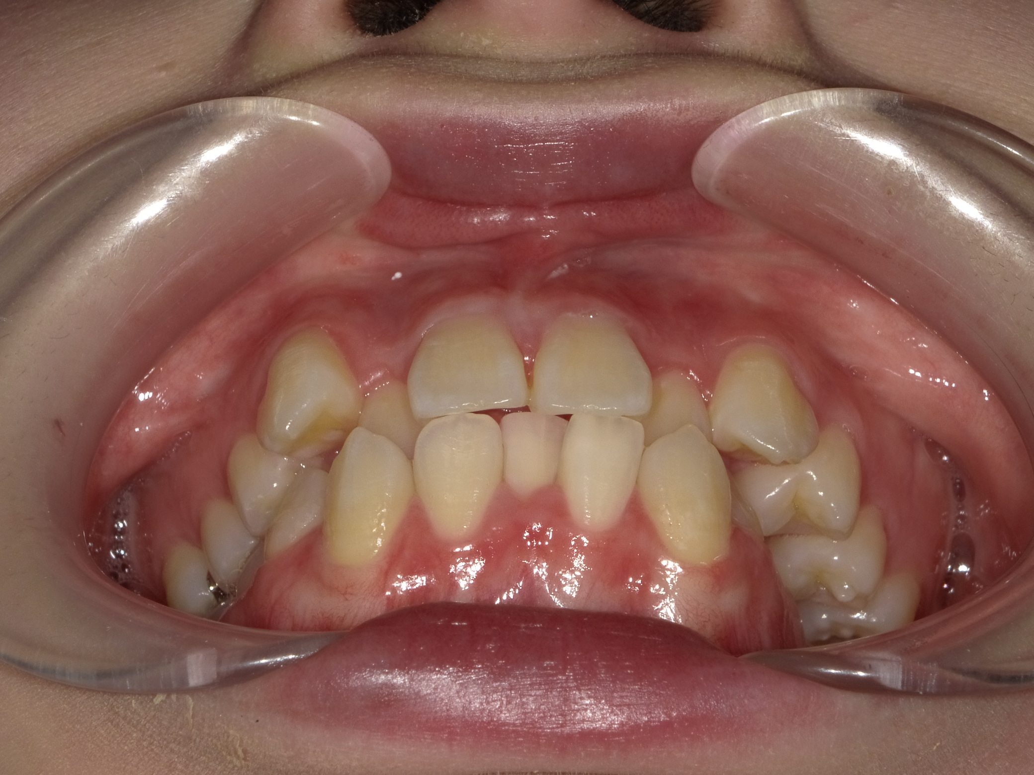 八重歯および左側が噛めていない症例　②