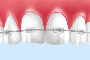 ブラケット矯正