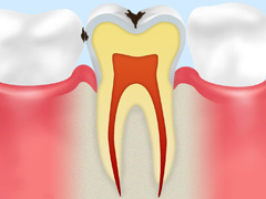 虫歯の進行と段階に応じた治療方法