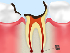 虫歯の進行と段階に応じた治療方法