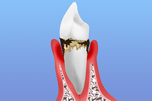 放置すると歯が抜ける？歯周病の怖さ
